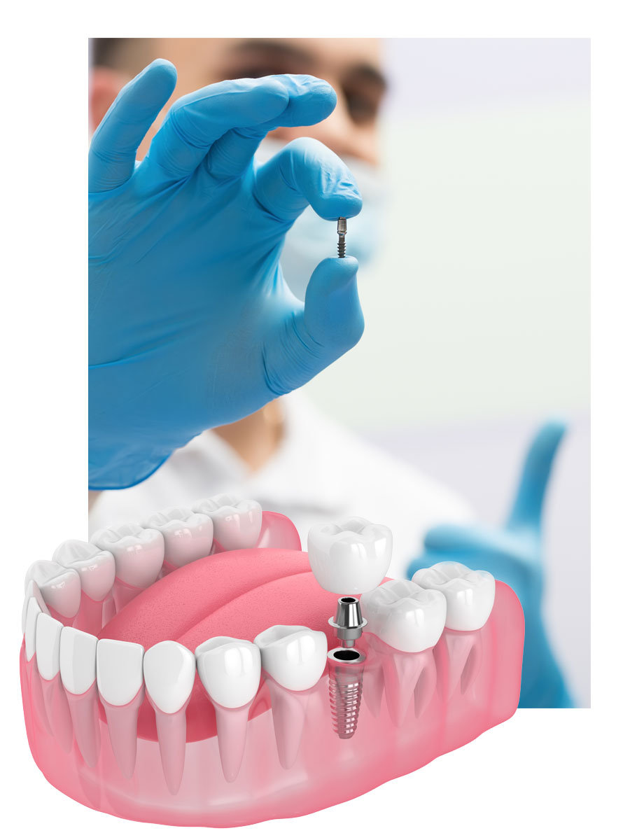 dental implants and module representation